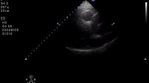 расслаивающей аневризмы корня и восходящего отдела аорты  5