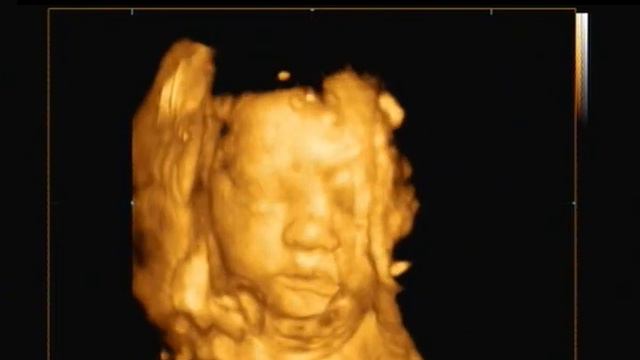 3D-4D УЗИ: пуповина перед лицом ребенка смотреть онлайн