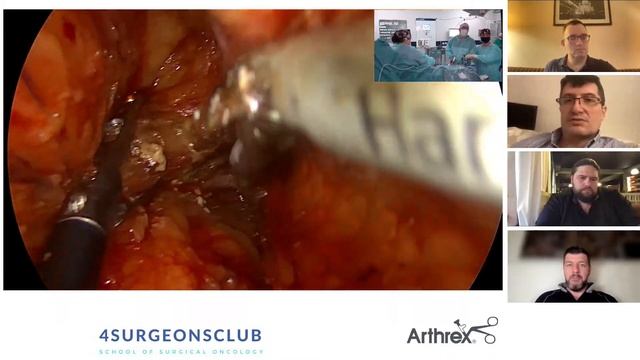 «Цветные Картинки» Arthrex Synergy 4К: Лап передняя резекция после формирования разгрузочной стомы смотреть онлайн