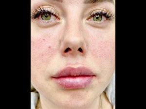 Аугментация губ