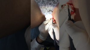 Папилома паховой области.