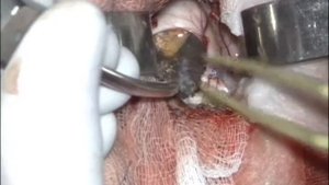 вскрытие кисты краниофарингеомы