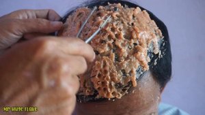 Psoriasis Removing | Dandruff Scratching (M219)