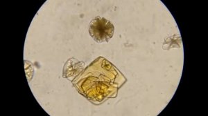 Моча под микроскопом.  Кристаллурия 4