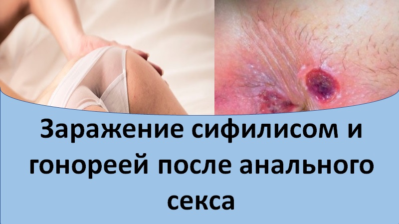 Заражение сифилисом и гонореей при анальном сексе