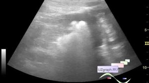 Детское УЗИ почек - Гиперэхогенный почечный синус с акустической тенью