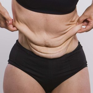 Что делать с обвисшей кожей после резекции желудка?