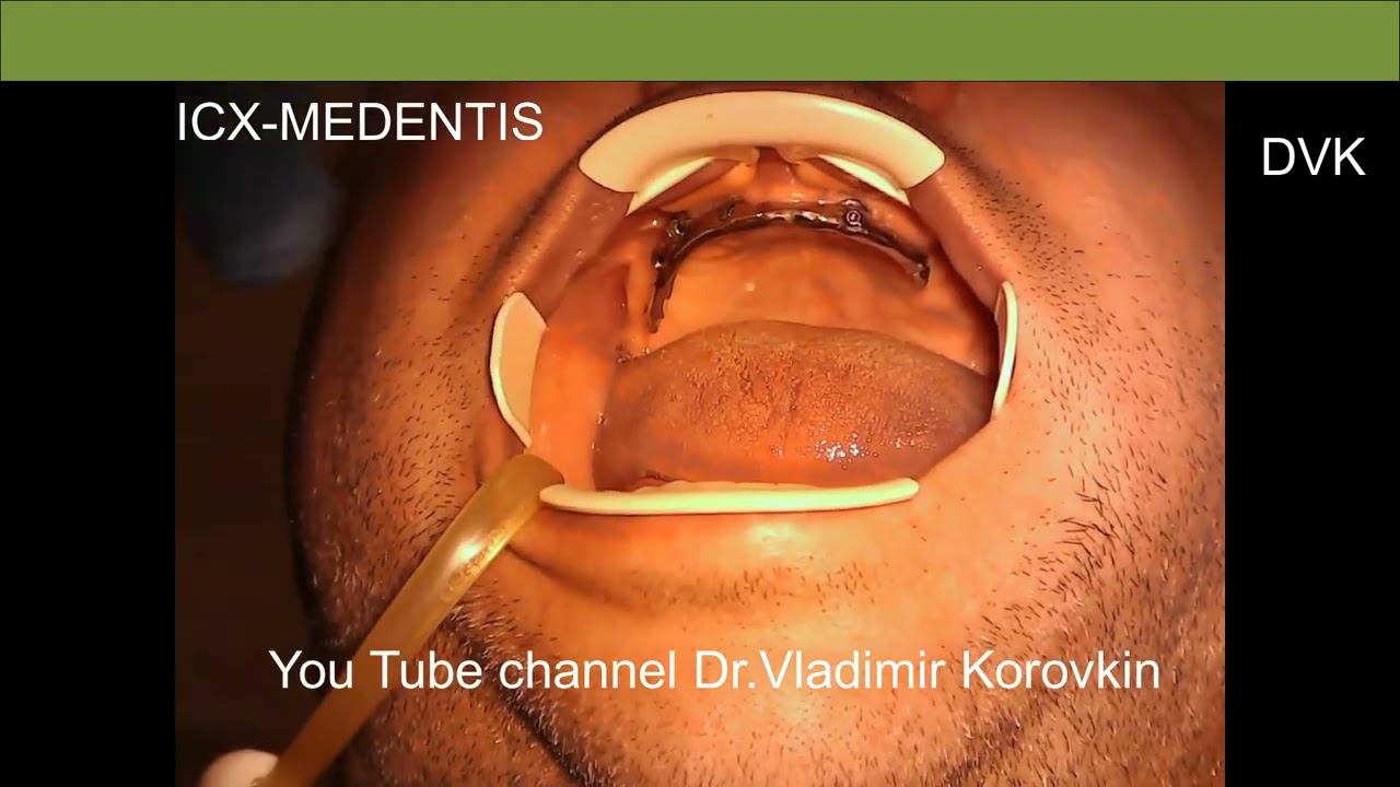 Фиксация балочной конструкции на имплантах.#ICXMedentis#implantodontia #implant #implantesdentarios