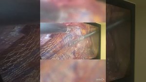 strangulation hernia, ущемление паховой грыжи