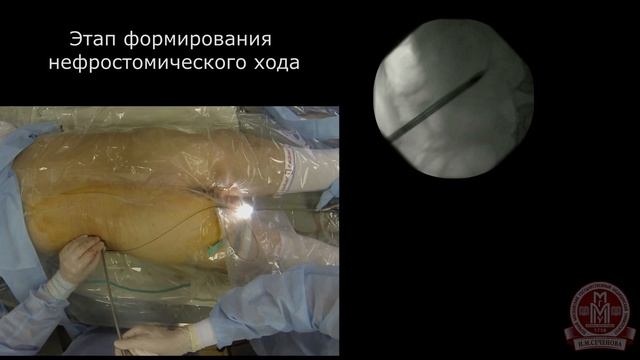 Мини перкутанная нефролитотрипсия смотреть онлайн