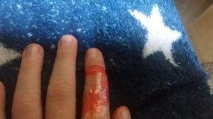 отрубил палец один месяц назад