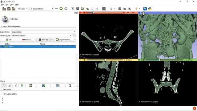 3D Slicer Tutorial(Bone Segmentation)