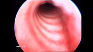 Мальформация трахеи.  Стентирование трахеи