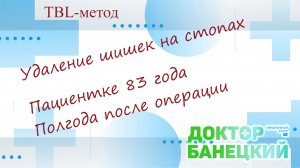 TBL - метод. Лечение косточек на стопах. Отзыв пациентки 83х лет. полгода после операции.