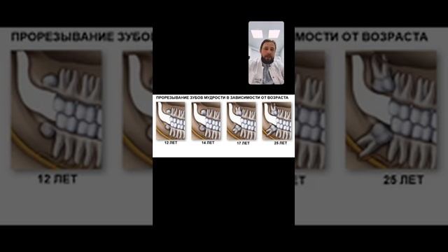 Удаление зуба «мудрости», удаление зуба , удаление восьмого зуба , удаление восьмерки смотреть онлайн