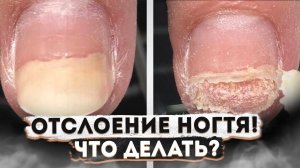 ОТСЛОИЛСЯ НОГОТЬ. ЧТО ДЕЛАТЬ? Что делать при онихолизисе | MEDPED