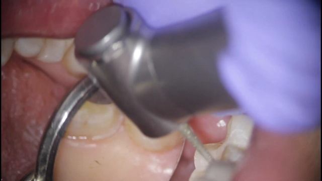 Препарирование зуба под коронку и лечение кариеса смотреть онлайн