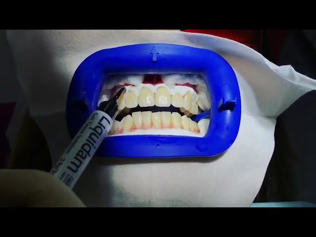 Отбеливание зубов Philips Zoom! WhiteSpeed