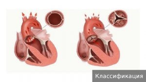 Недостаточность трехстворчатого клапана. Как лечить недостаточность трехстворчатого клапана.