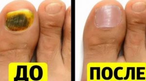 Невероятно! Удали Грибок Ногтей за Полчаса - расскажу КАК!