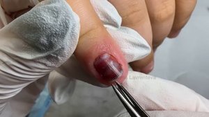Синяк под ногтем / Ударила ноготь что делать / Ушиб ногтя / Травма ногтя / Болит ноготь