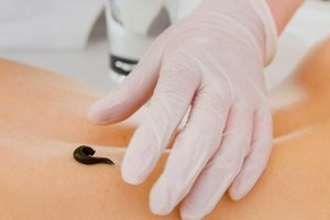 Можно ли лечить варикоз пиявками?