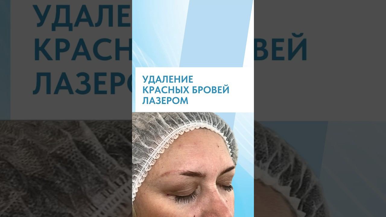 УДАЛЕНИЕ КРАСНЫХ БРОВЕЙ | БЫСТРО И НЕ БОЛЬНО