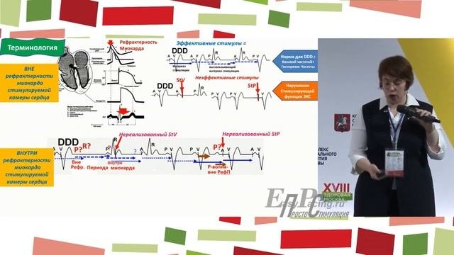 Кардиостимуляция. Базовые функции кардиостимулятора и их ЭКГ-отображение