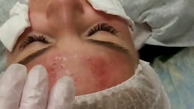 АирисКом студенты учатся: мезотерапия. Пилинг и ретиноевая маска при акне и жирной коже. смотреть онлайн