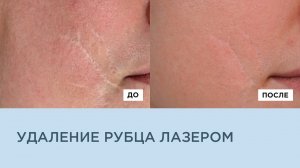 УДАЛЕНИЕ РУБЦА ЛАЗЕРОМ