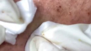 Relaxing Acne Treatment Acnes Treatment  97