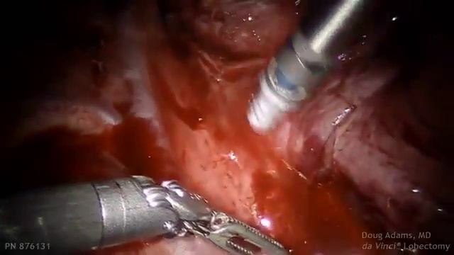 Suction Irrigator Video Clip for dV Lobectomy смотреть онлайн