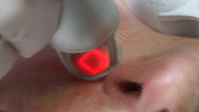 Фракционное омоложение. Лечение постакне. Избавление от рубцов. смотреть онлайн