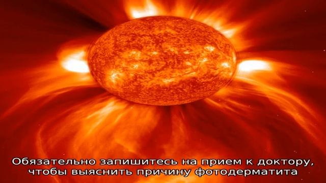 Аллергия на солнце: чем опасен и как лечить фотодерматит смотреть онлайн