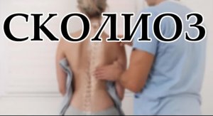 ? СКОЛИОЗ - как вылечить (симптомы, причины и лечение)