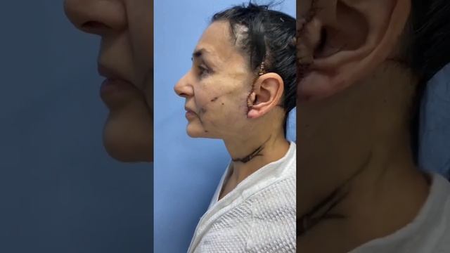 Подтяжка лица и шеи со смас лифтингом, верхняя и нижняя блефаропластика. смотреть онлайн