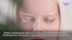 Чеченская девочка - альбинос с гетерохромией. Амина Эпендиева.