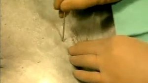 Надключичный блок