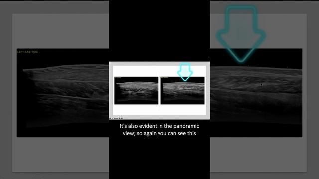 #ultrasound Guided Interventions: Cases (Proximal Gastrocnemius Tear)