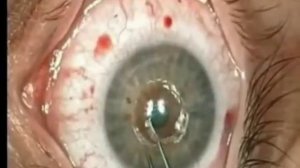 Имплантация интрастромальных роговичных сегментов