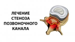 Лечение стеноза позвоночного канала поясничного отдела