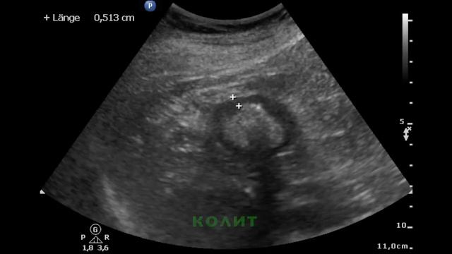 066 - УЗИ - Колит смотреть онлайн
