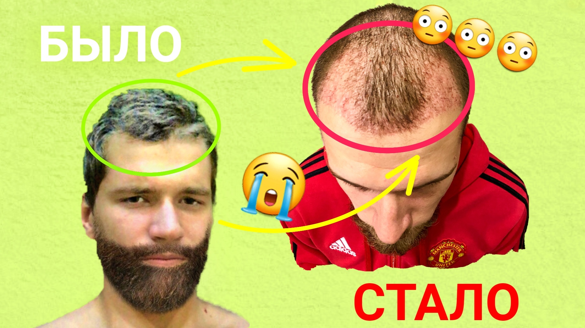 Пересадка волос в России. Блог #3