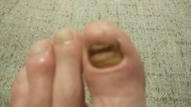 Отбитый ноготь часть 7. Придавленный ноготь лечение без врача. Ноготь уже отпал смотреть онлайн