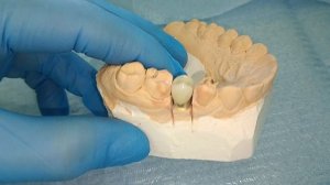 протезирование