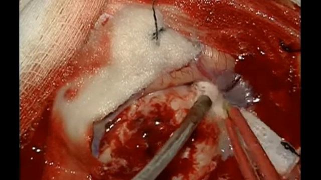 парасагитальная менингиома смотреть онлайн