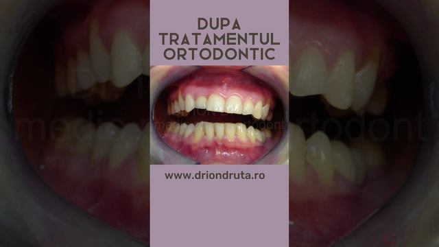 Caz rezolvat Dr. Ion Druta #tratamentortodontic #aparatdentar #medic #ortodont #dintialiniaticorect