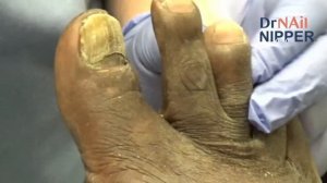 What causes thick toenails? No Thick Toenails Here... Keep Moving (2022)