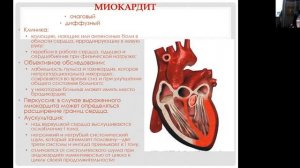 Острая ревматическая лихорадка