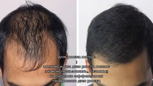 Наращивание волос мужчинам: простой способ скрыть облысение